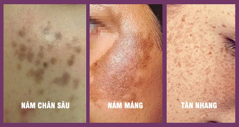 bi-nam-da-mat-phai-lam-sao-de-cai-thien-a4